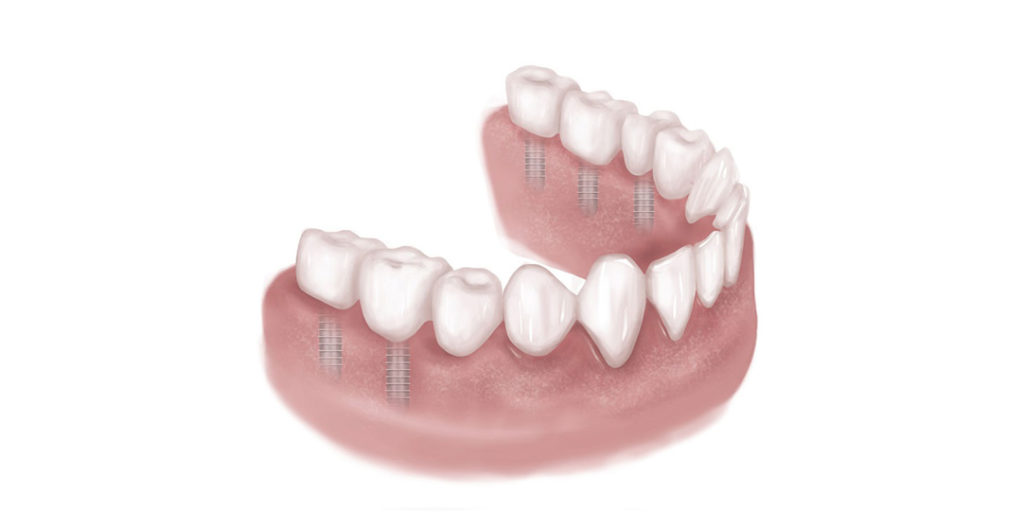 Dental implants and crowns replace teeth and preserve bone