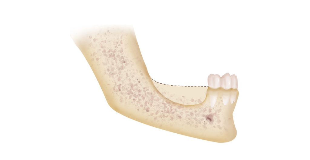 Bone resorption where posterior teeth are missing