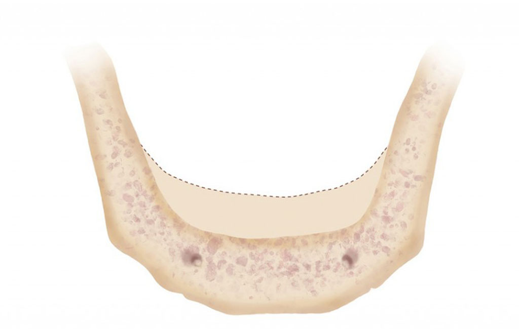 Bone resorption occurs when all teeth are missing