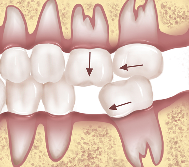 Problems associated with a missing posterior tooth